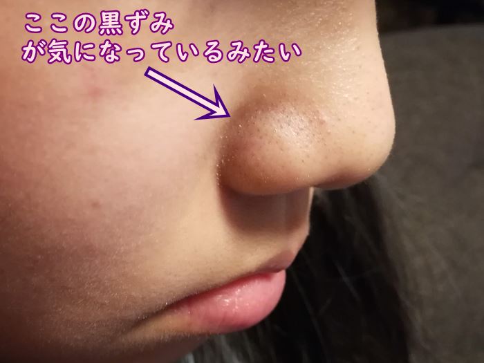 娘の小鼻の黒ずみ部分の写真